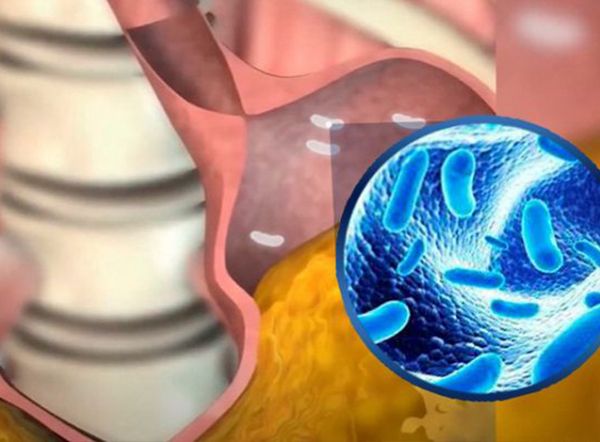 Chuyên gia nói gì về LiveSpo COLON – Bào tử lợi khuẩn cho người viêm đại tràng