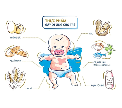 Sử dụng probiotic để điều trị dị ứng thực phẩm ở trẻ em