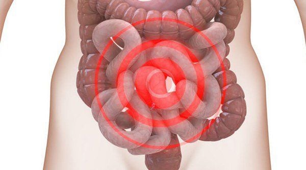 Hội chứng ruột kích thích: Nguyên nhân, triệu chứng và phương pháp xử lý hiệu quả