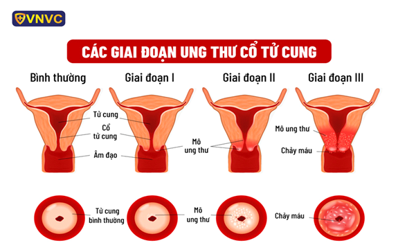 Vai trò của men vi sinh đối với ung thư cổ tử cung