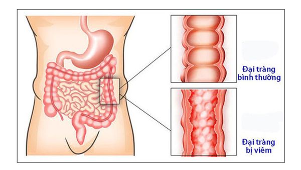 Viêm đại tràng điều trị khó không? TẤT TẦN TẬT về bệnh đại tràng