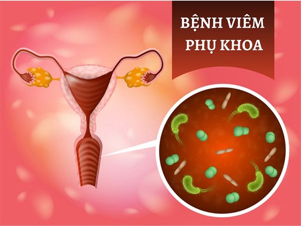Viêm phụ khoa là gì? Nguyên nhân, triệu chứng và cách phòng bệnh viêm phụ khoa