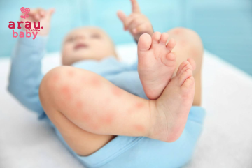 Những bệnh ngoài da thường gặp ở trẻ sơ sinh
