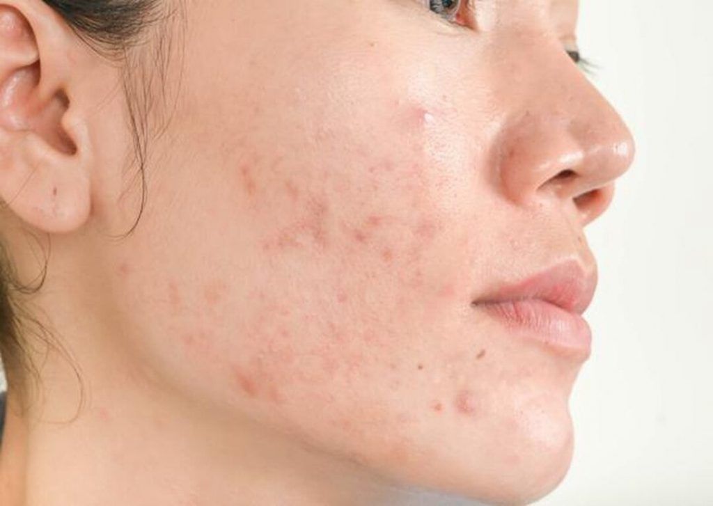Chăm sóc da mụn thế nào để không để lại thâm?