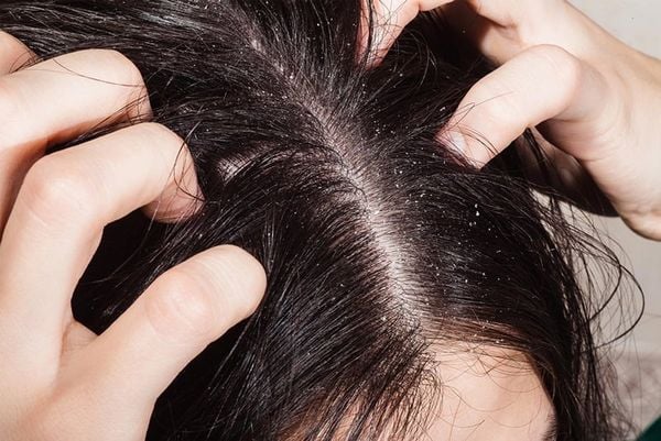 Giải mã nguyên nhân gây gàu ngứa da đầu mùa hè và cách xử lý
