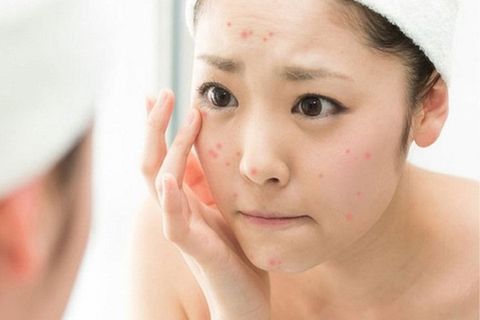 Tuổi dậy thì nên dùng sữa rửa mặt gì để ngăn mụn?