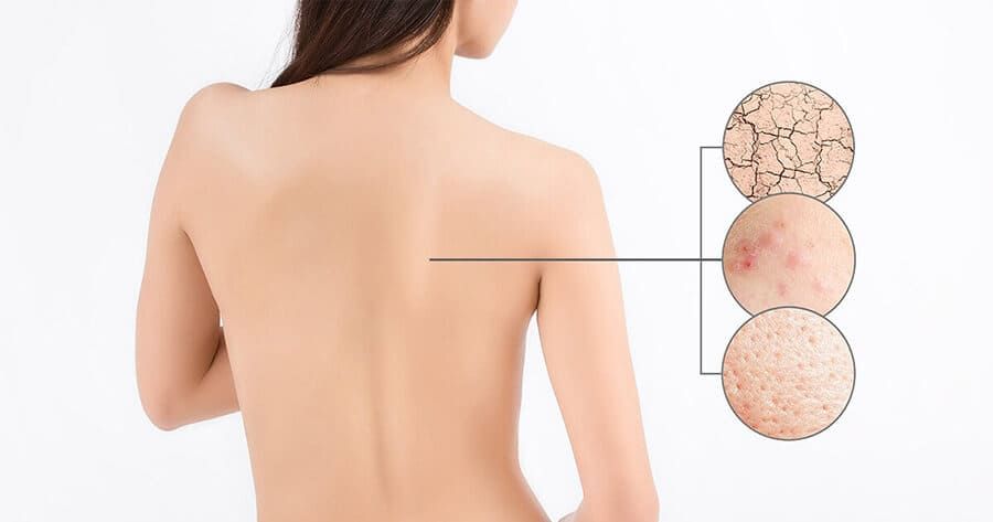 Mụn lưng, viêm lỗ chân lông do chọn sai sữa tắm