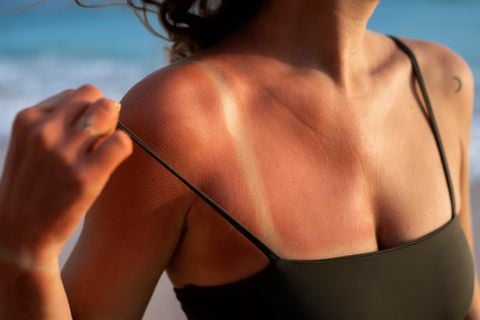 Da cháy nắng sau du lịch biển: Cách làm dịu da và phục hồi tự nhiên