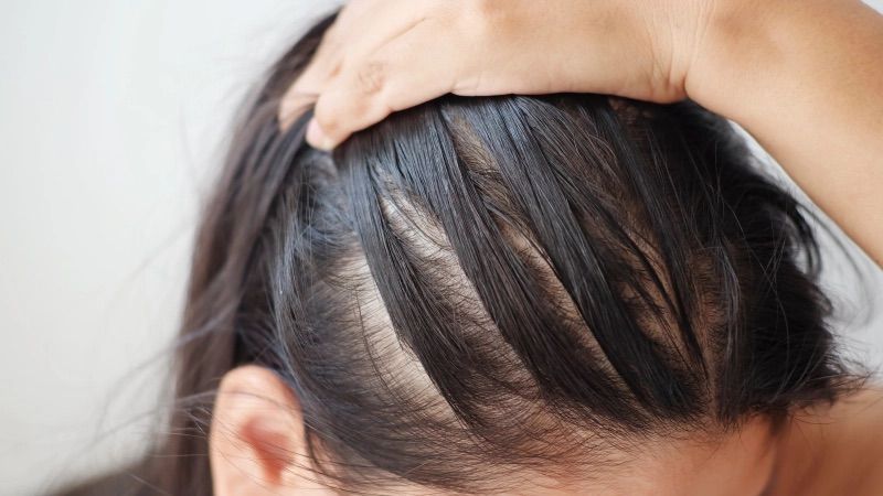 Tại sao tóc bị rụng và cách ngăn ngừa triệt để