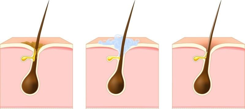 Lỗ chân lông thường dễ bị bít tắc do bã nhờn, bụi bẩn