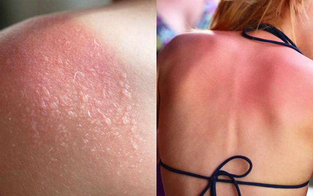 Da cháy nắng có dấu hiệu gì?