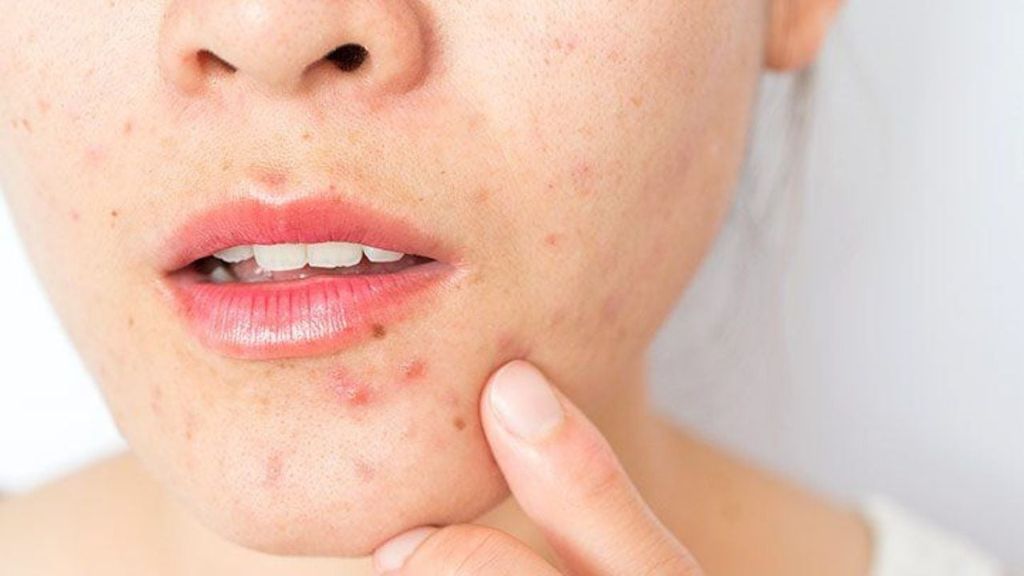 Tại sao tuổi dậy thì hay bị lên mụn?