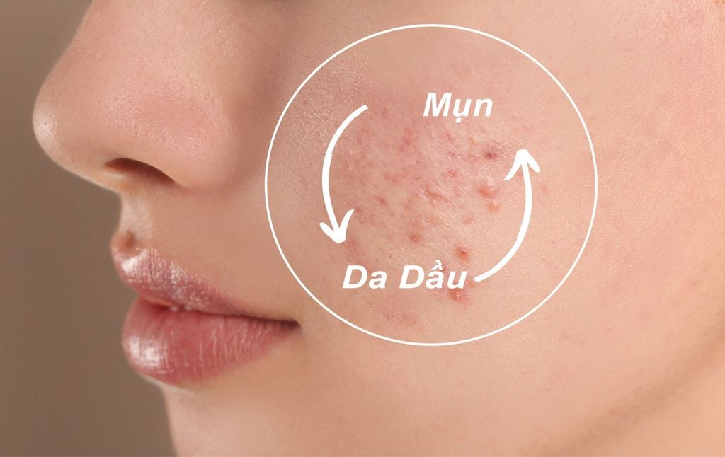 Da dầu dễ bị nổi mụn hơn các loại da khác