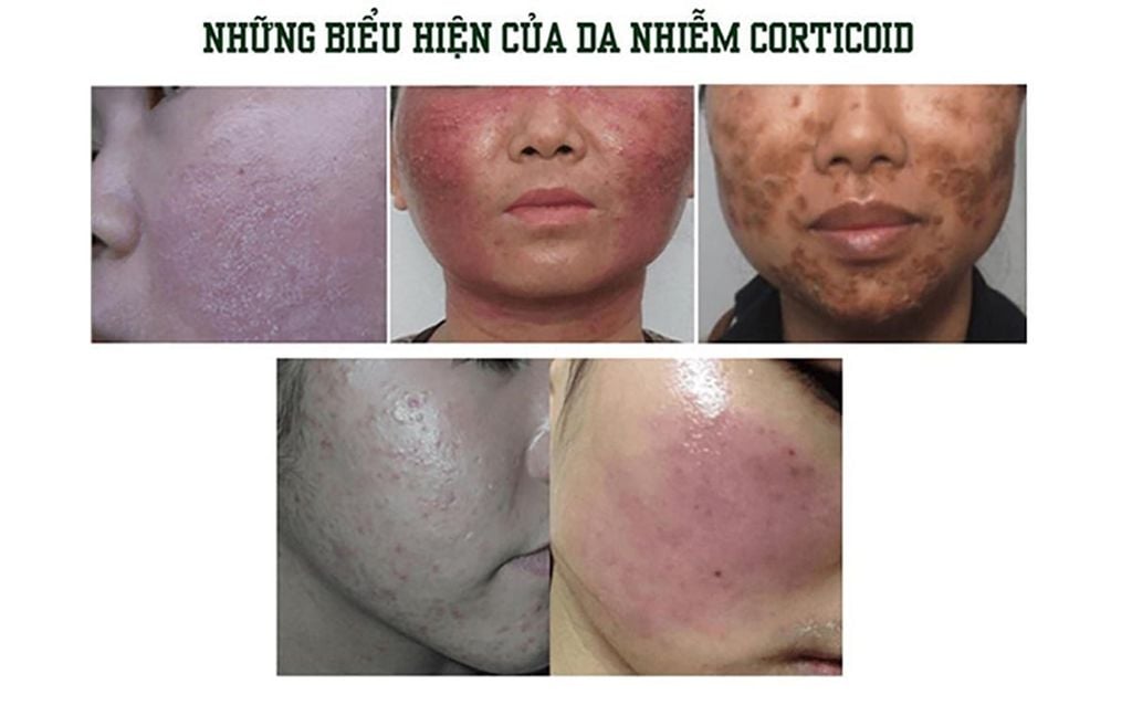 những tác hại khôn lường của kem trộn