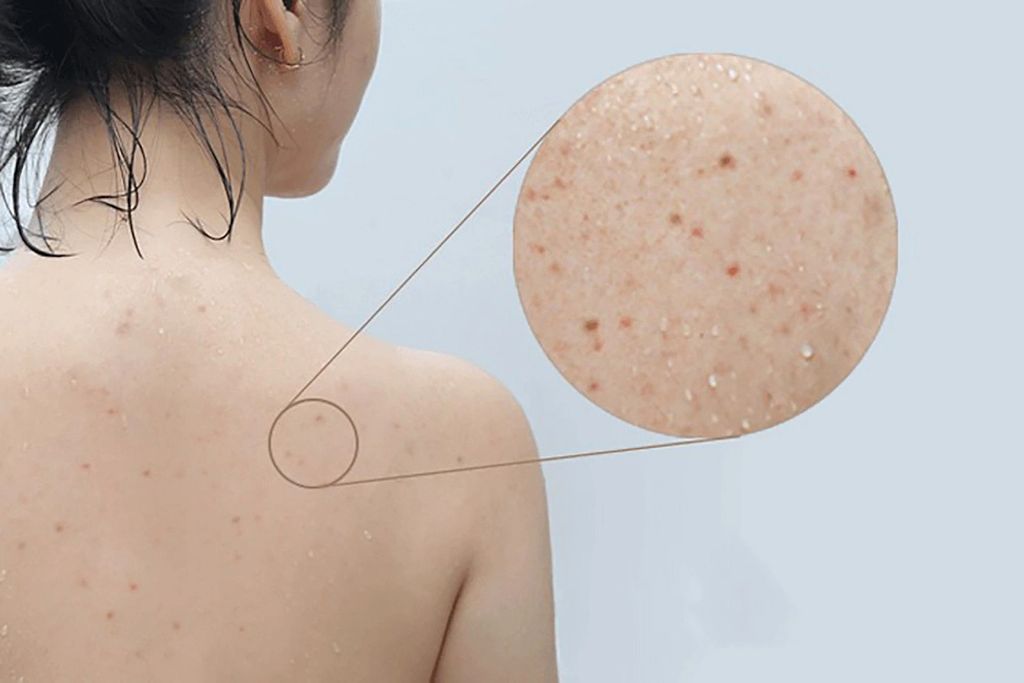 Mụn lưng, viêm nang lông khiến da bị tổn thương không đều màu
