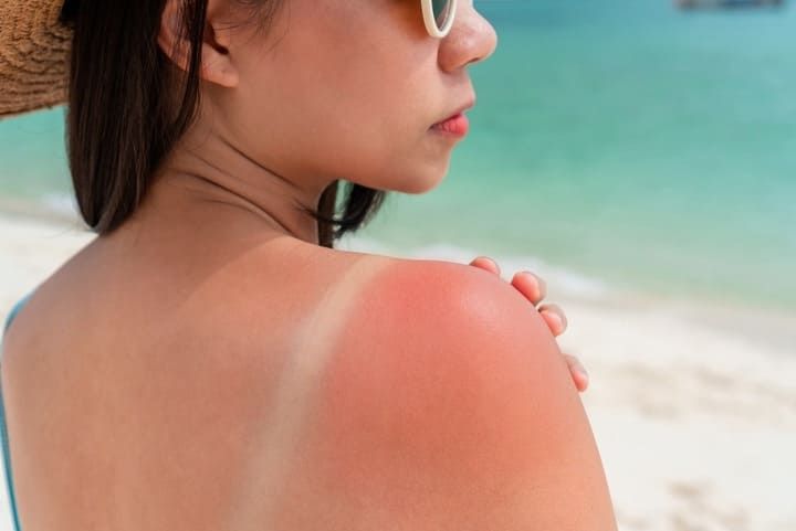 ánh nắng khiến da đen sạm màu kém rạng rỡ