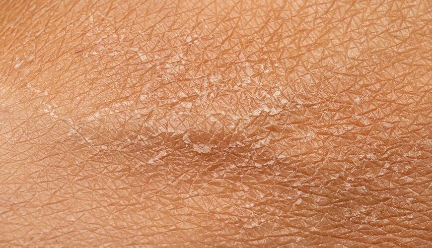 Cận cảnh làn da bị khô sần thiếu ẩm