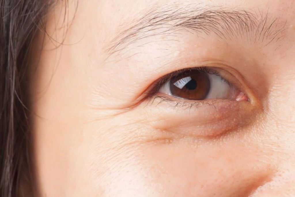Làn da lão hoá, xuất hiện nếp nhăn quanh mắt
