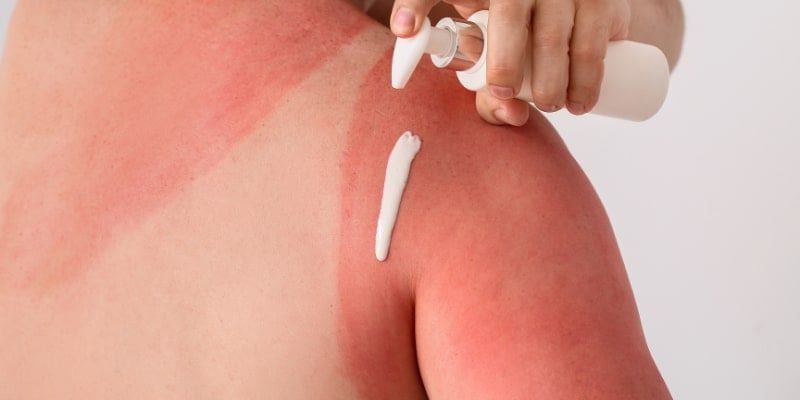 Làm sao để da cháy nắng trắng trở lại?