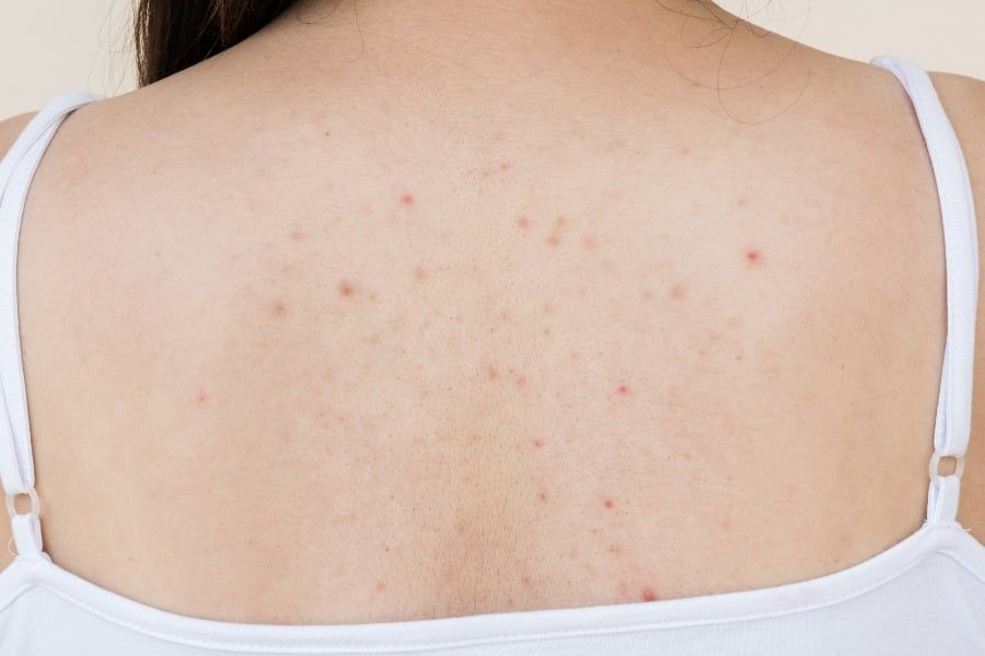 Làn da da thâm mụn body cần các sản phẩm chăm sóc da phù hợp
