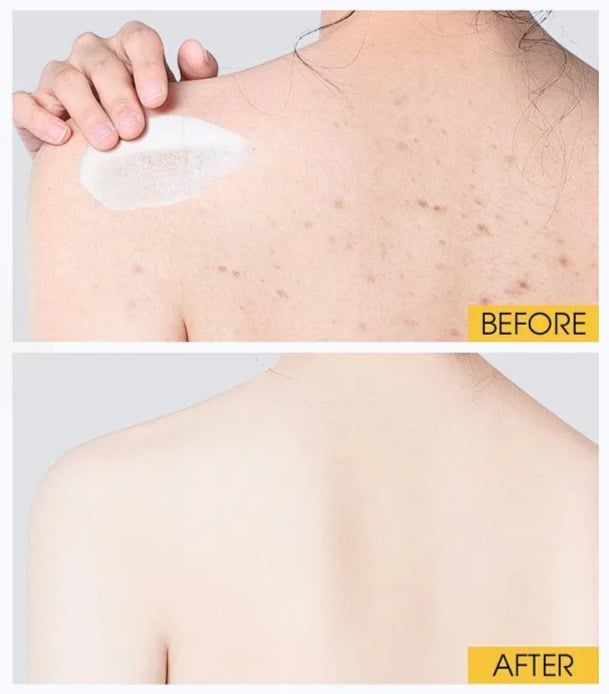 Cách làm mờ thâm body như thế nào?