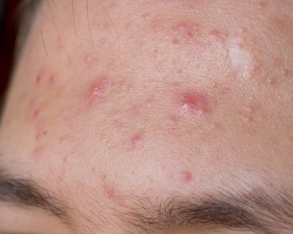 Dầu, bã nhờn làm lỗ chân lông bị bít tắc gây mụn