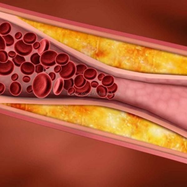 Rối loạn mỡ máu kiêng ăn gì