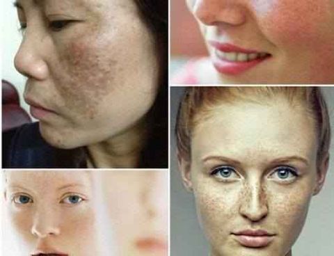 NÁM DA TÁI PHÁT VÀ NGUY CƠ TIỀM ẨN