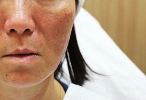 Làm sao làm mờ nám gò má?