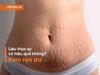Kem rạn da có thể giảm vết rạn không? Đánh giá khách quan