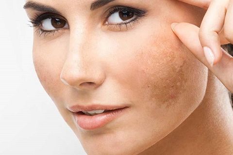Đôi điều cần biết về melanin và nám da