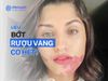 Bớt rượu vang bẩm sinh có hết được không?