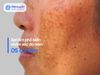 Bác Sĩ Chỉ Ra 5 Sai Lầm Khi Chăm Sóc Da Nám