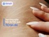 Top Công Nghệ Trị Rạn Da Hiện Đại Mang Lại Hiệu Quả Vượt Trội