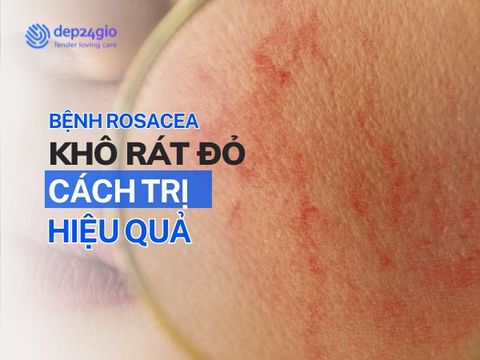 Da Mặt Bị Khô Rát Đỏ: Rosacea và Cách Điều Trị Tối Ưu