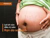 Trị rạn da sau sinh sớm: Lợi ích bất ngờ mà bạn chưa biết