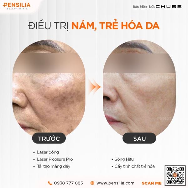 tri-nam-tan-nhang-o-dau-tot-nhat-truoc-sau