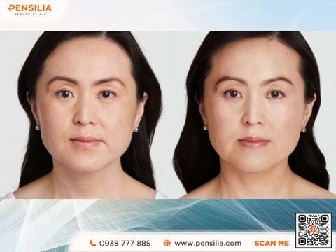 cach-giam-nong-cam-ultherapy-truoc-sau