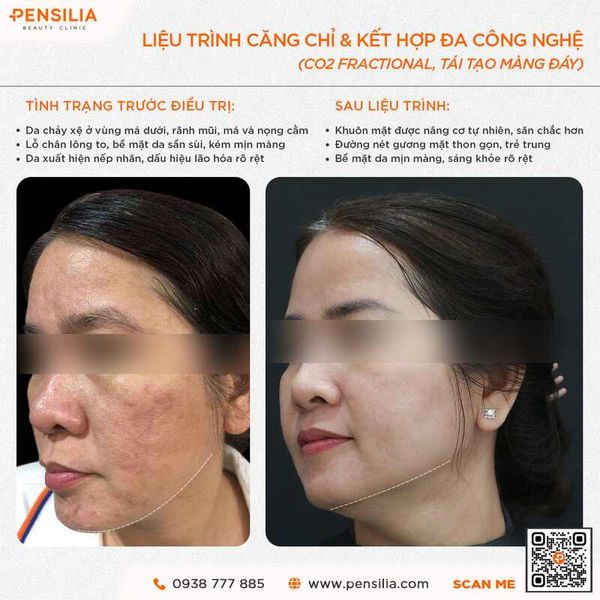 cang-chi-collagen-aptos-namica-truoc-sau