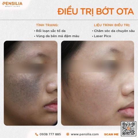 nam-chan-sau-picosure-pro-truoc-sau