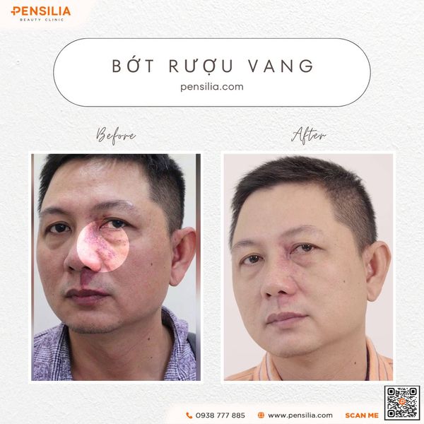 bot-ruou-vang-truoc-sau