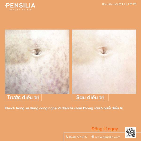 cong-nghe-tri-ran-da-2