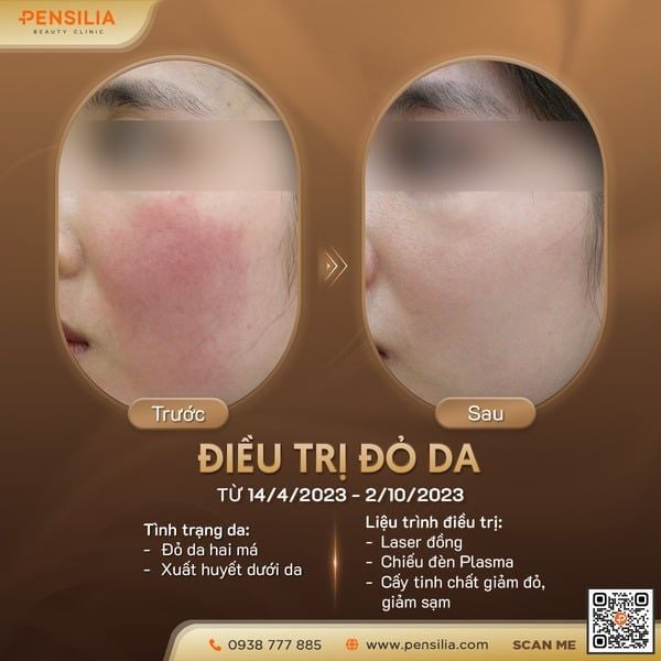mat-bi-do-2-ben-ma-truoc-sau-pensilia-do-da-rosecea