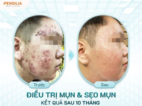 tri-mun-truoc-sau