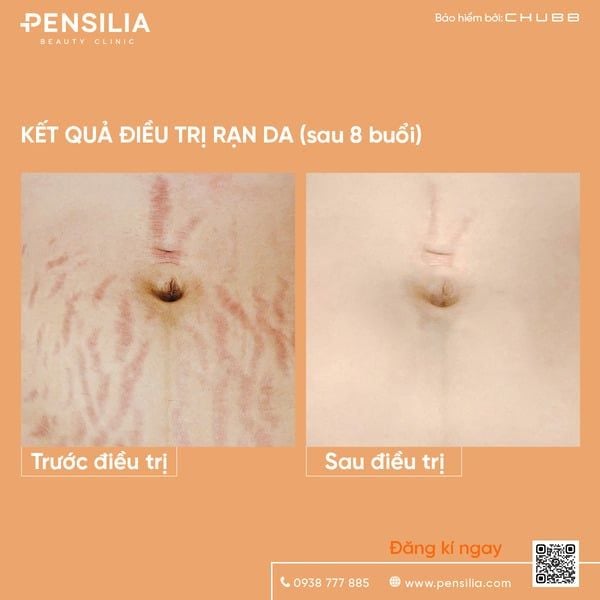 tri-ran-da-sau-sinh-truoc-sau