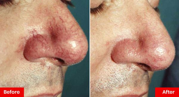 da-mat-bi-kho-rat-do-truoc-sau-rosacea