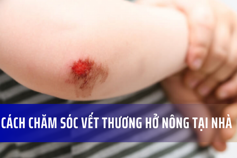 Cách chăm sóc vết thương hở và vết cắt nông tại nhà