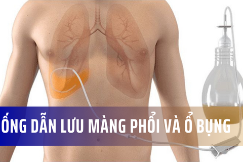 Tổng quan về ống dẫn lưu cho phổi và ổ bụng