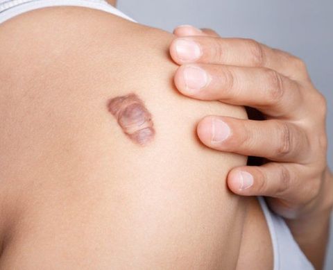 Cách điều trị sẹo lồi mới hình thành