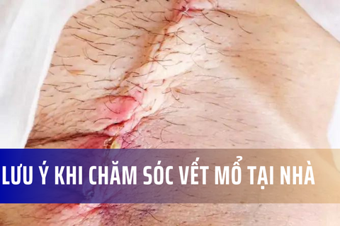 Những lưu ý khi chăm sóc vết mổ tại nhà